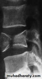 Injuries of the thoracic spine