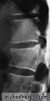 Injuries of the thoracic spine