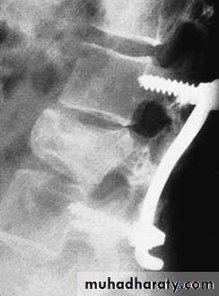 Injuries of the thoracic spine