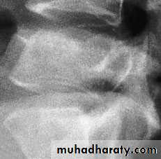Injuries of the thoracic spine