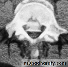 Injuries of the thoracic spine