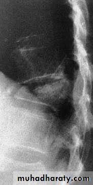 Injuries of the thoracic spine