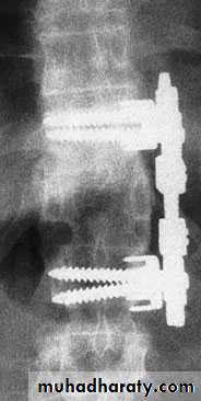 Injuries of the thoracic spine