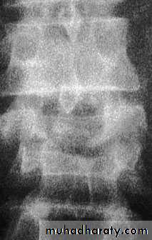 Injuries of the thoracic spine