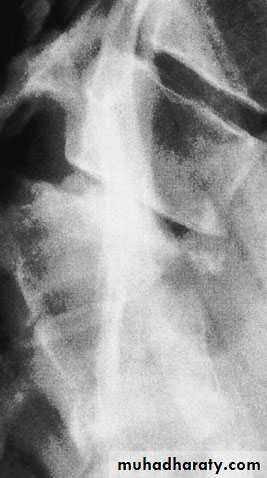 Injuries of the thoracic spine