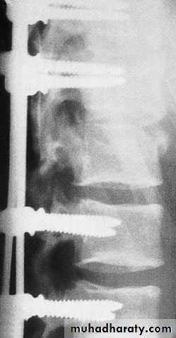 Injuries of the thoracic spine