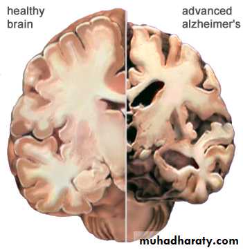 ALS and DEmntia