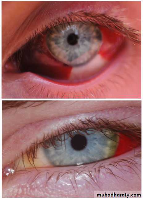 Pertusis and Varicella