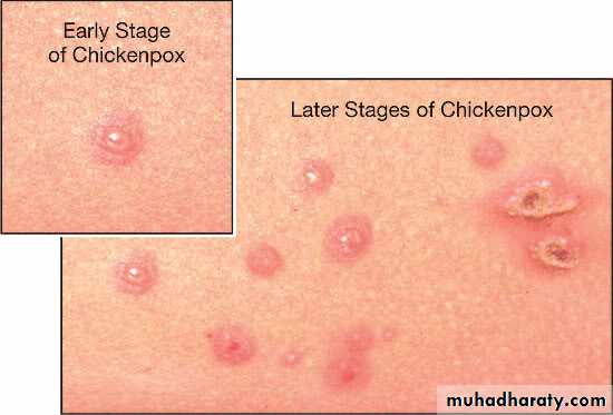 Pertusis and Varicella