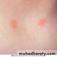 Pertusis and Varicella