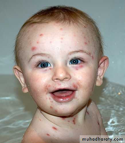 Pertusis and Varicella
