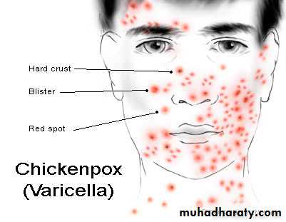 Pertusis and Varicella