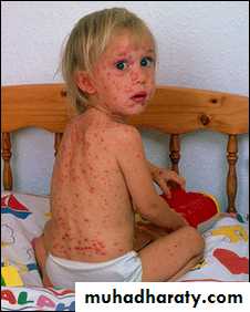 Pertusis and Varicella