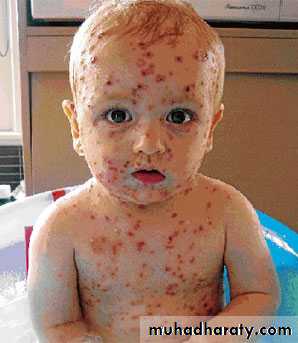 Pertusis and Varicella
