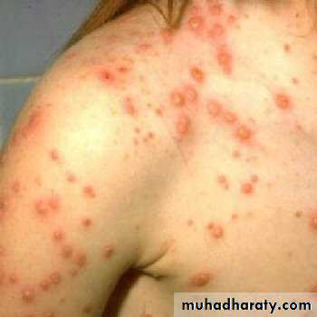 Pertusis and Varicella