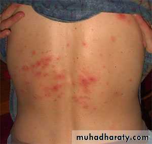 Pertusis and Varicella