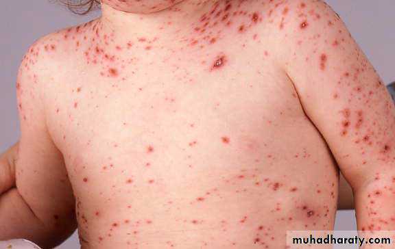 Pertusis and Varicella
