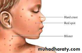 Pertusis and Varicella