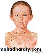 Pertusis and Varicella