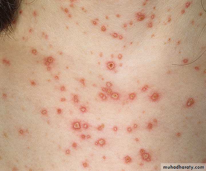 Pertusis and Varicella