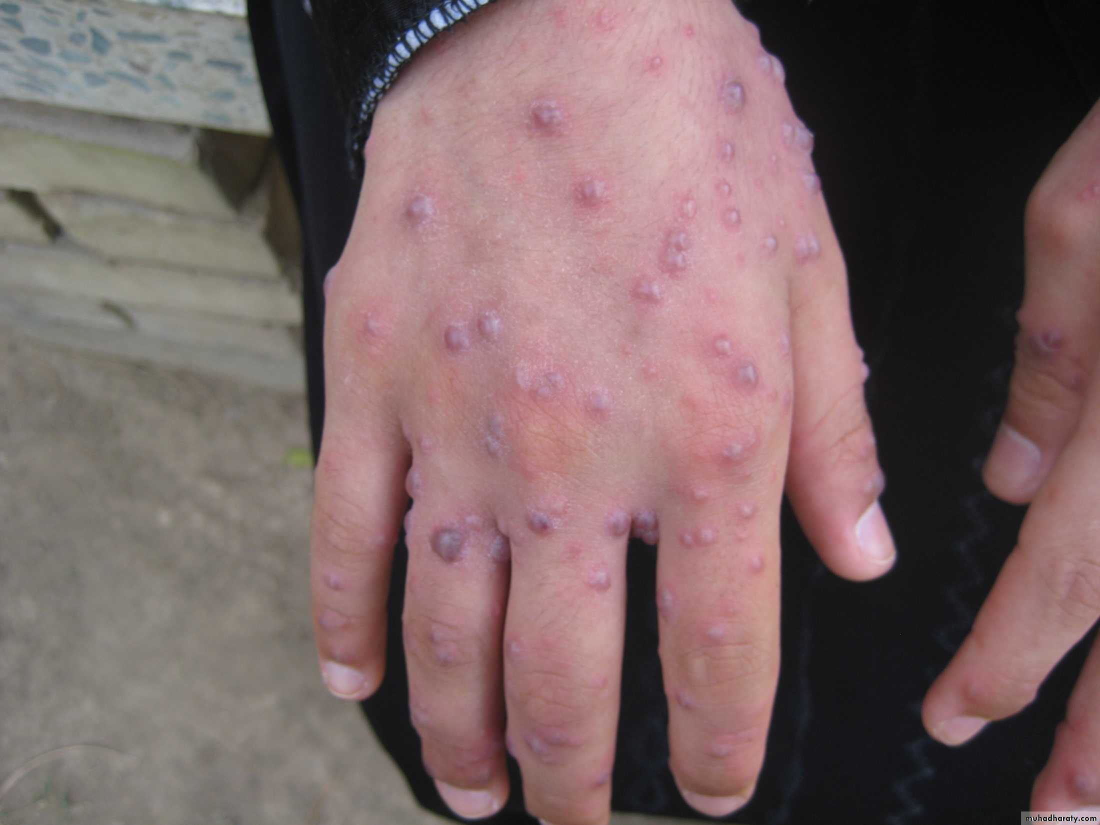 Pertusis and Varicella