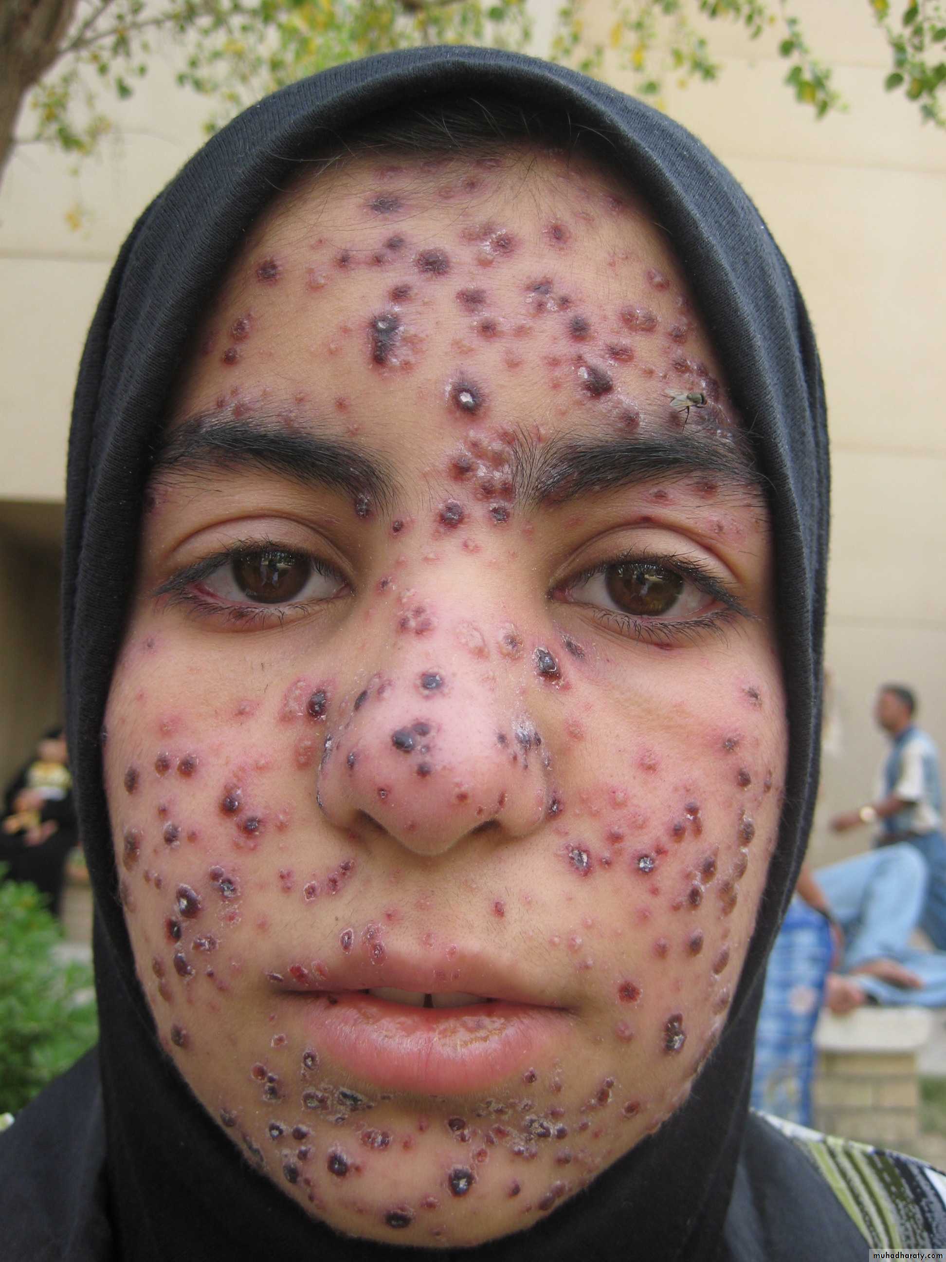 Pertusis and Varicella
