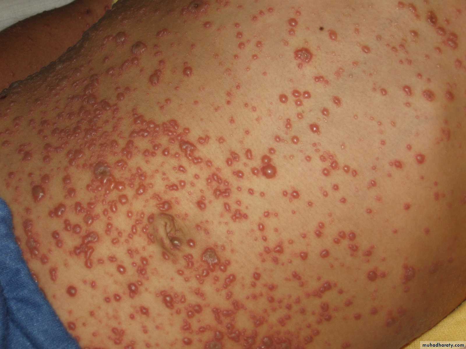 Pertusis and Varicella
