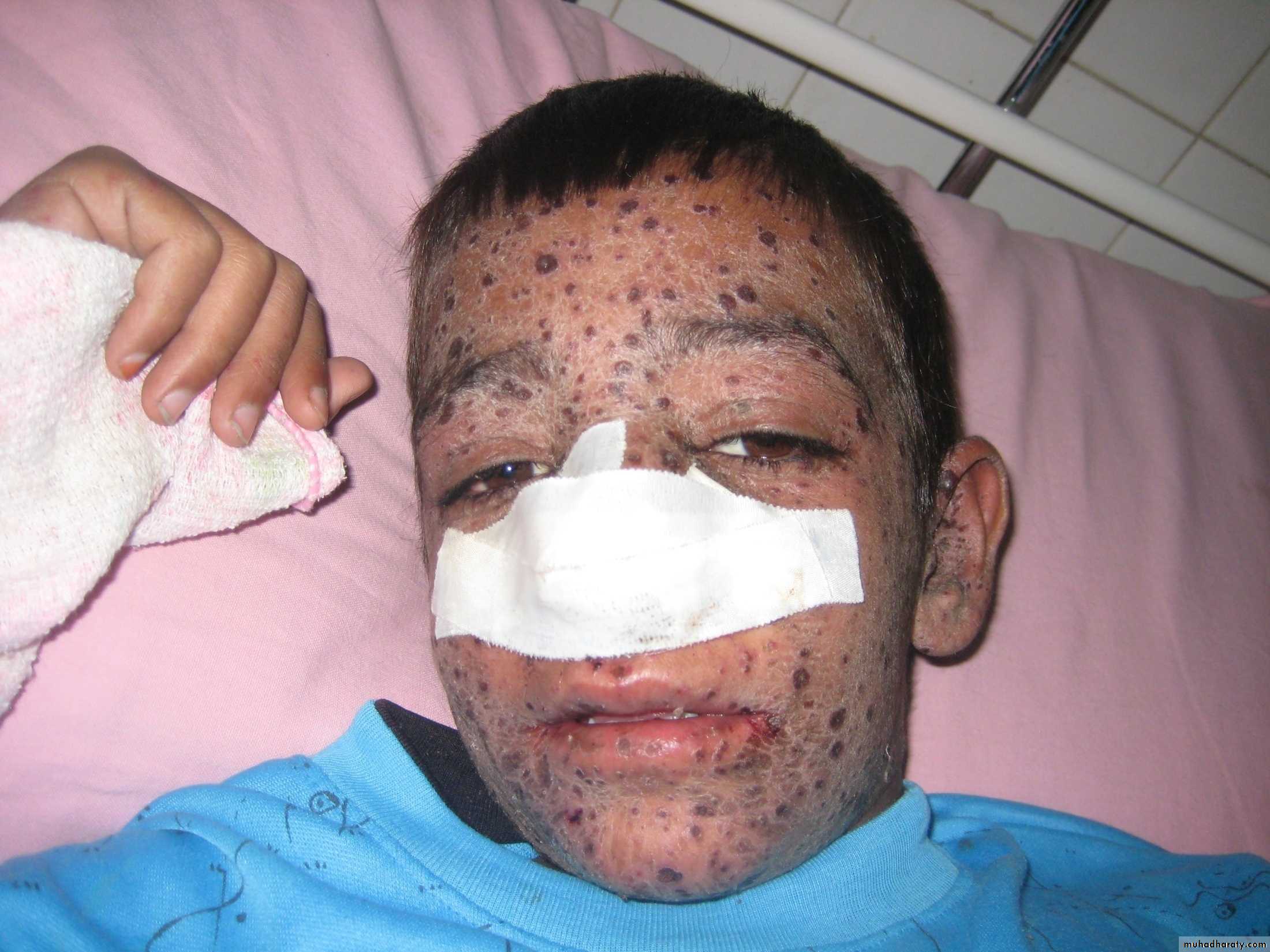 Pertusis and Varicella