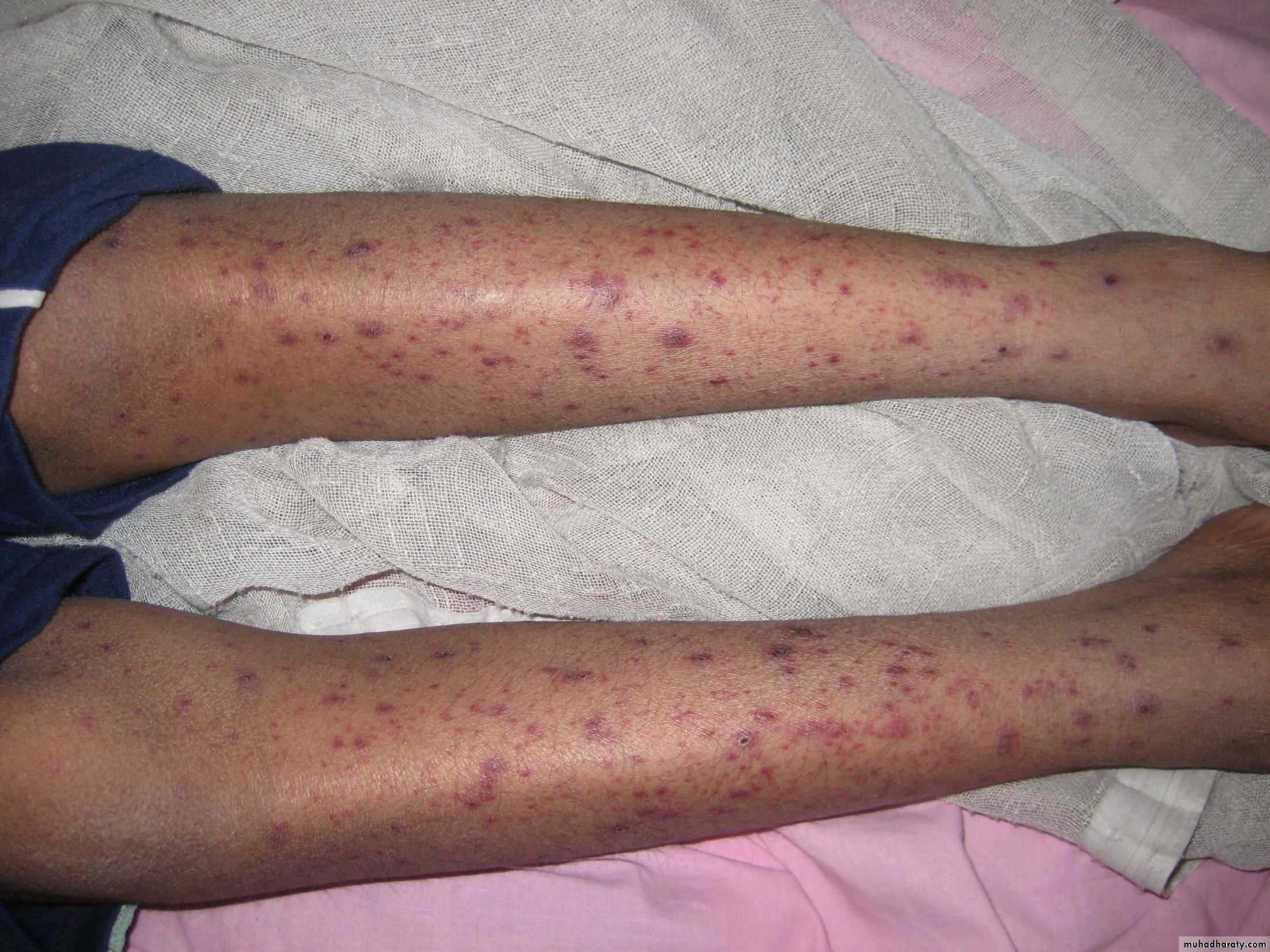 Pertusis and Varicella
