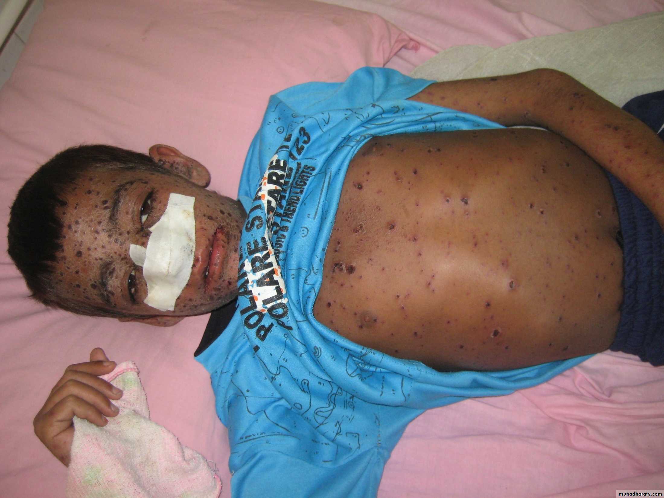 Pertusis and Varicella