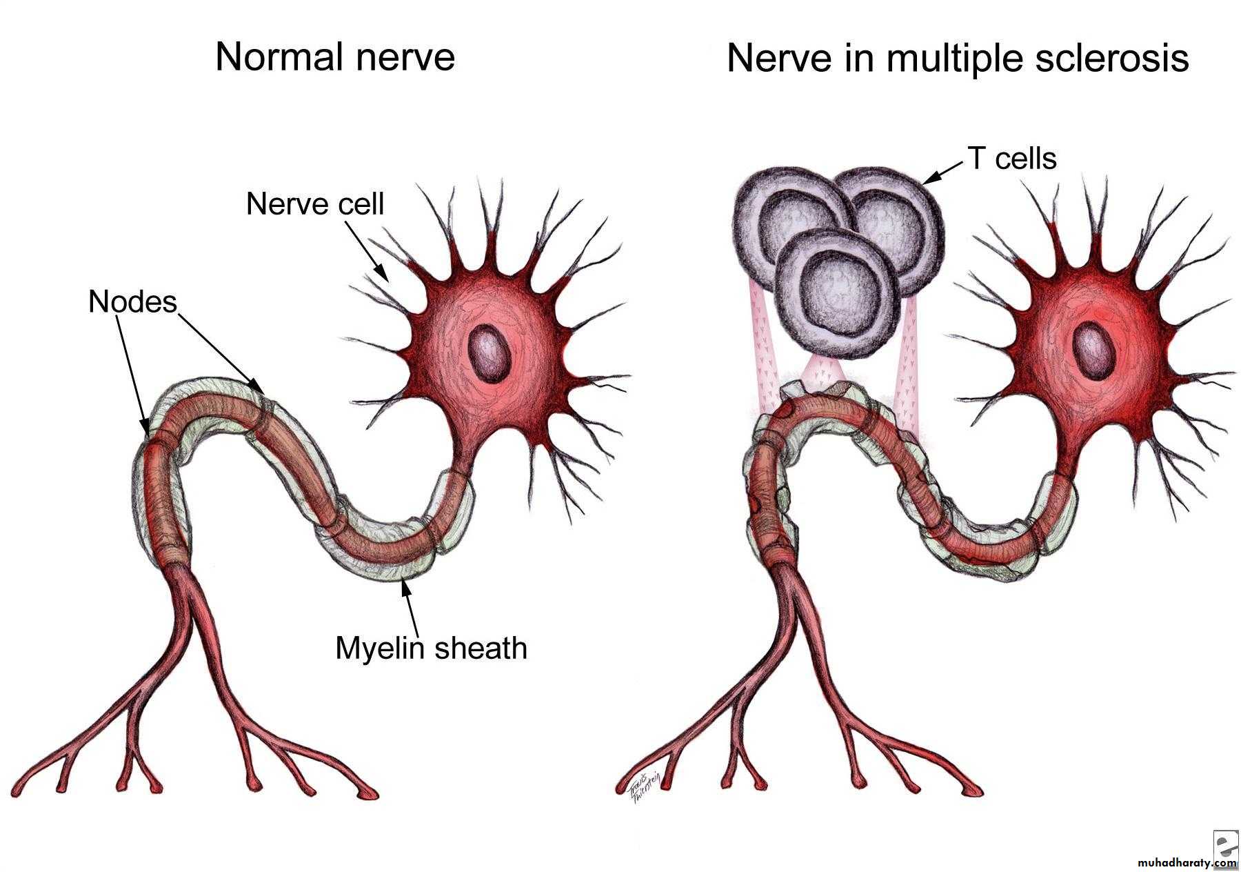 Periphral neuropathy
