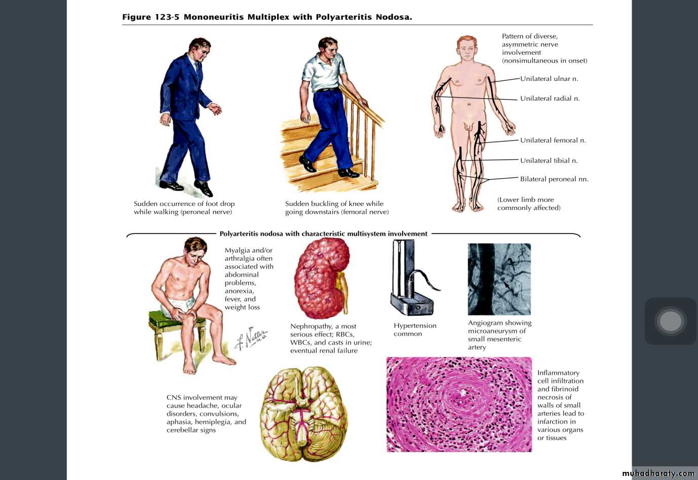 Periphral neuropathy