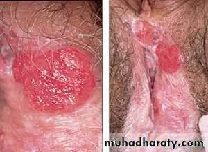 disease of vulva 2