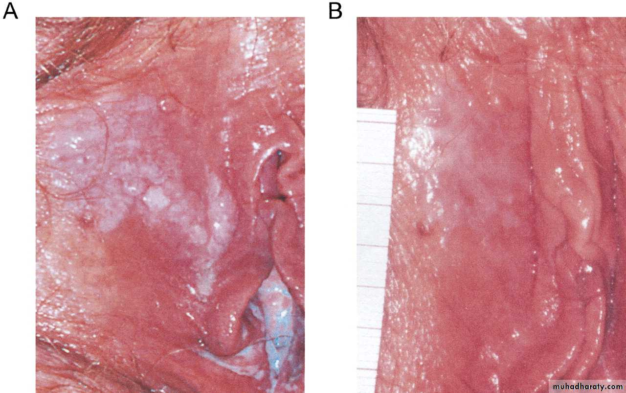 disease of vulva 2