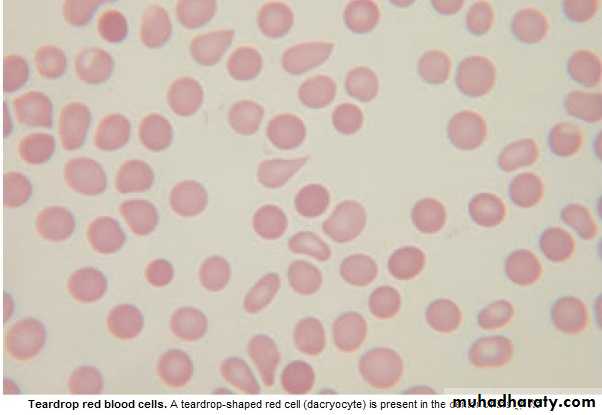 multiple myeloma