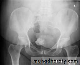 Cervical dysplasia