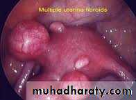 Cervical dysplasia slides