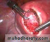 Cervical dysplasia slides