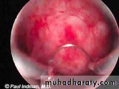 Cervical dysplasia slides