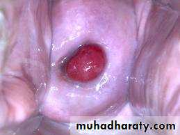 Cervical dysplasia slides