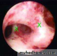 Cervical dysplasia slides