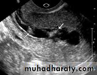 Cervical dysplasia slides
