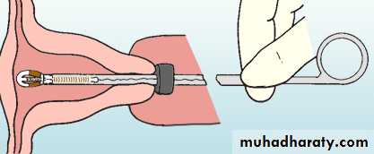 CONTRACEPTION
