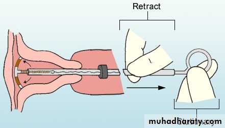 CONTRACEPTION