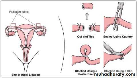 CONTRACEPTION