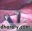 CONTRACEPTION