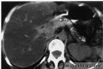 Endoscopic GIT