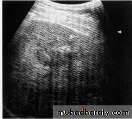 Endoscopic GIT
