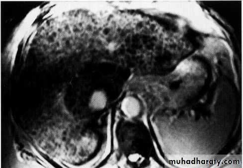 Endoscopic GIT