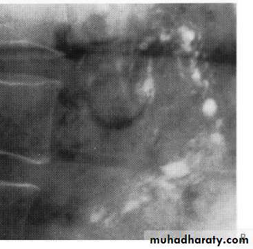 Endoscopic GIT